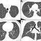 Computed tomography chest scans showing numerous “tree-in-bud” nodules (the white blobs) associated with popcorn lung.